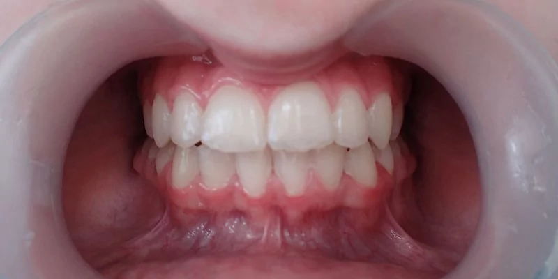 После - Ультразвуковая чистка